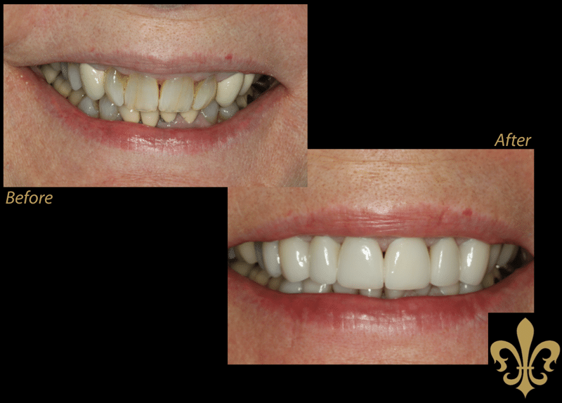 Before and After Photos of Veneers
